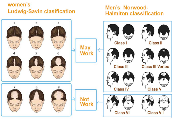 men and women's hair loss classifications