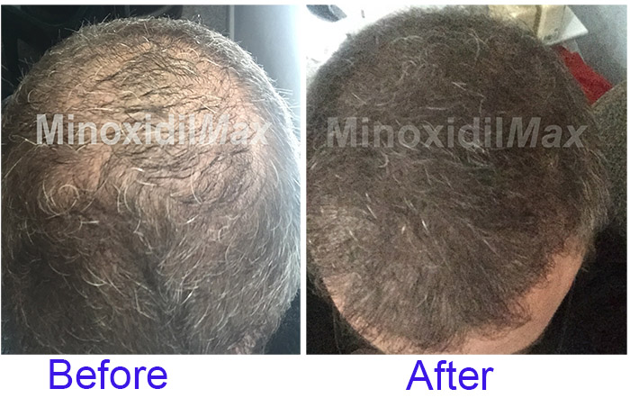 10% minoxidil results