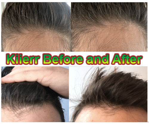Kiierr Laser Hair Growth Cap review, Amazing Results