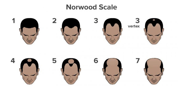 elon musk hair loss norwood scale