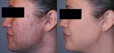 microneedling acne scar removal