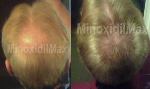 Topical Finasteride | Professionally Formulated | Save $$$