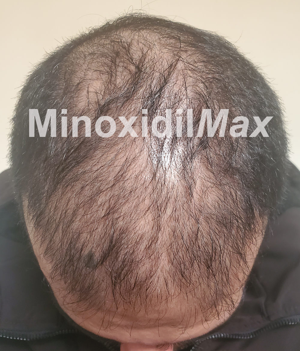 Topical Finasteride without Minoxidil | Buy Essengen-F