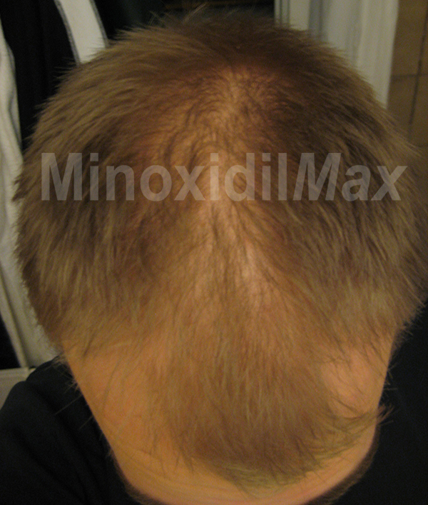 Minoxidil Results | Before & After Amazing Pictures