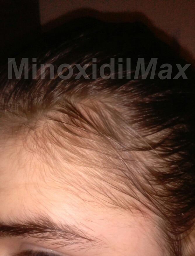 hair max plus minoxidil 5 results