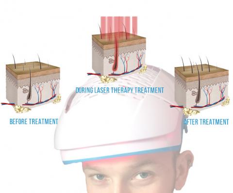 low level laser therapy for hair loss review